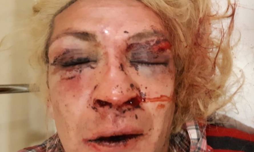 Brutal ataque en Puerto Montt: a golpes desfiguran rostro de mujer trans